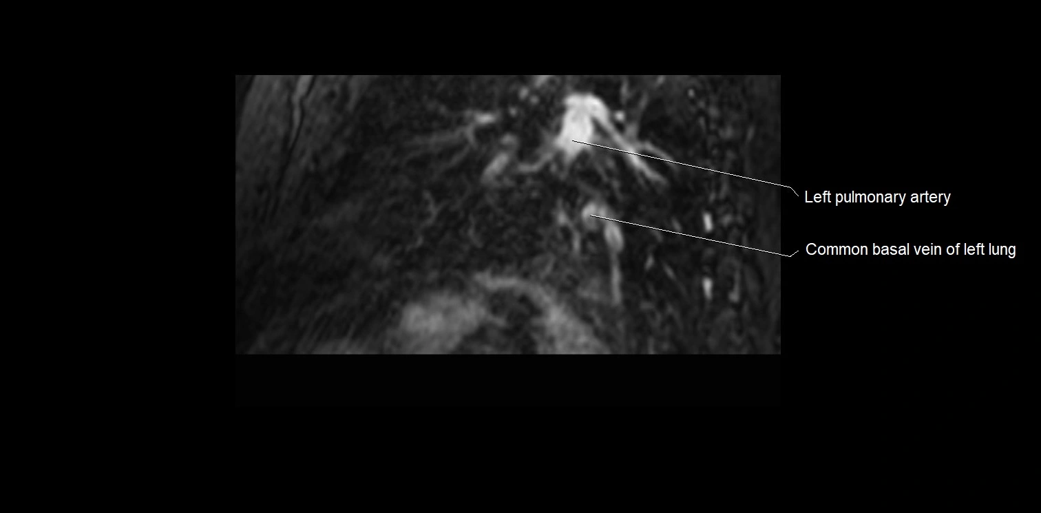 MRI heart and coronary arteries two chamber(sagittal)  anatomy image 41.webp